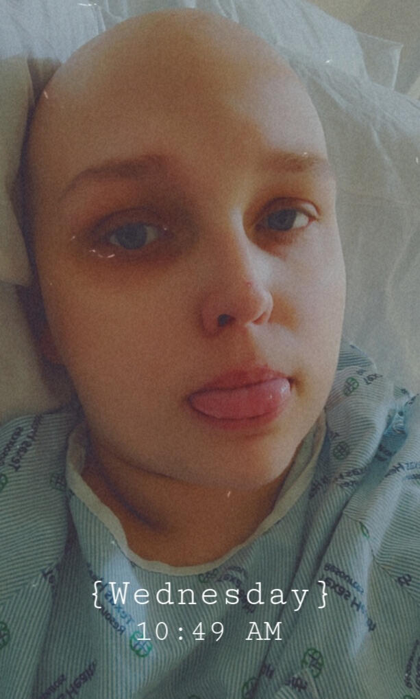 A selfie of me with a neutral facial expression, my tongue sticking out. I feature my bald head & I'm in a hospital gown. Snapchat date & time stamp is Wednesday at 10:49am